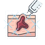 Keloid treatm ent