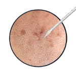 Subcision NEW