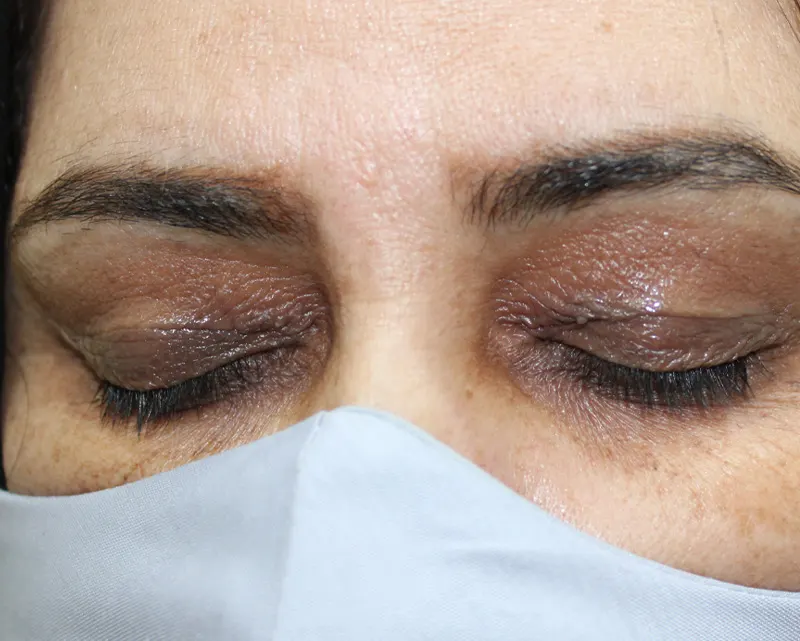جراحی محدود مطب دکتر پریسا ذبیحی بعدعمل زانتلاسما جراحی محدود مطب دکتر پریسا ذبیحی بعدعمل زانتلاسما