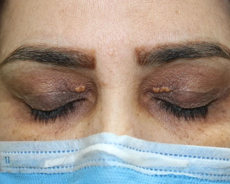 جراحی محدود مطب دکتر پریسا ذبیحی قبل عمل زانتلاسما جراحی محدود مطب دکتر پریسا ذبیحی قبل عمل زانتلاسما