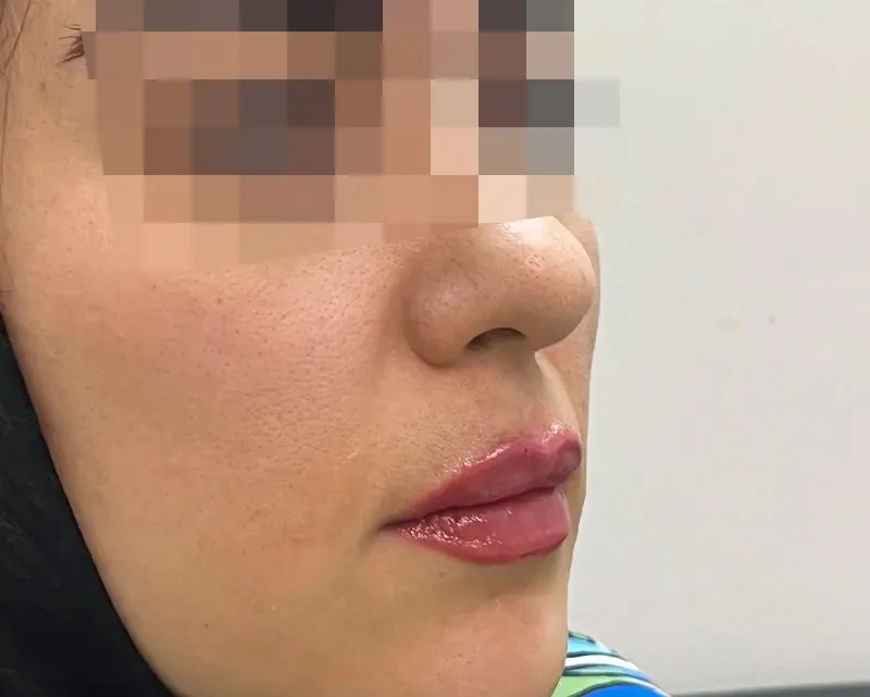 بعد از تزریق ژل لب توسط خانوم دکتر پریسا ذبیحی بعد از تزریق ژل لب توسط خانوم دکتر پریسا ذبیحی