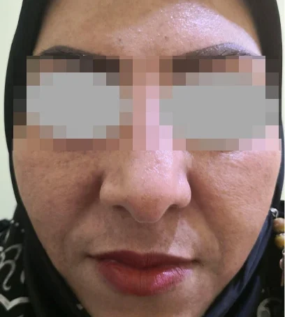 بعد پاکسازی پوست خالبراری-مطب-دکتر-پریسا-ذبیحی بعد پاکسازی پوست خالبراری-مطب-دکتر-پریسا-ذبیحی