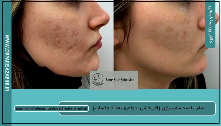 صفر تا صد سابسیژن (اثربخشی، دوام و تعداد جلسات) 2 صفر تا صد سابسیژن (اثربخشی، دوام و تعداد جلسات)