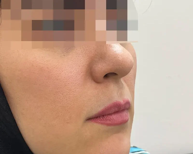 قبل تزریق ژل لب توسط خانوم دکتر پریسا ذبیحی قبل تزریق ژل لب توسط خانوم دکتر پریسا ذبیحی