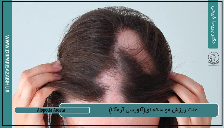 علت ریزش مو سکه ای(آلوپسی آره‌آتا)