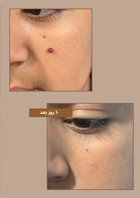خالبرداری ایمن با حفظ زیبایی پوست
