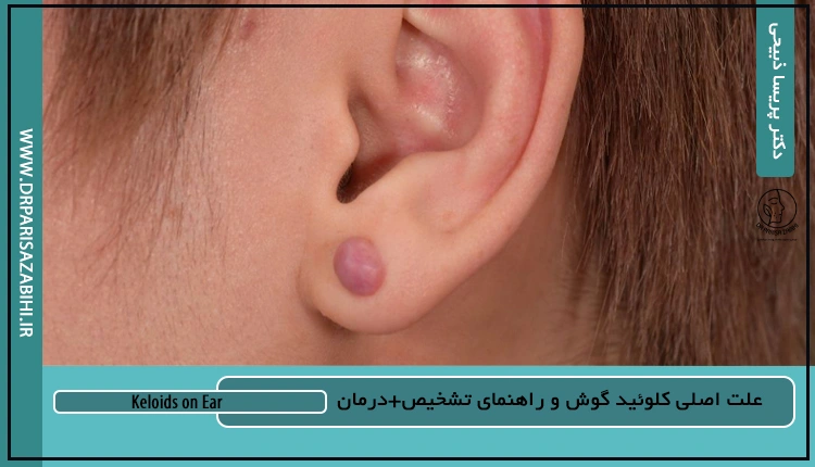 علت کلوئید گوش چیست؟ 2 علت کلوئید گوش چیست؟