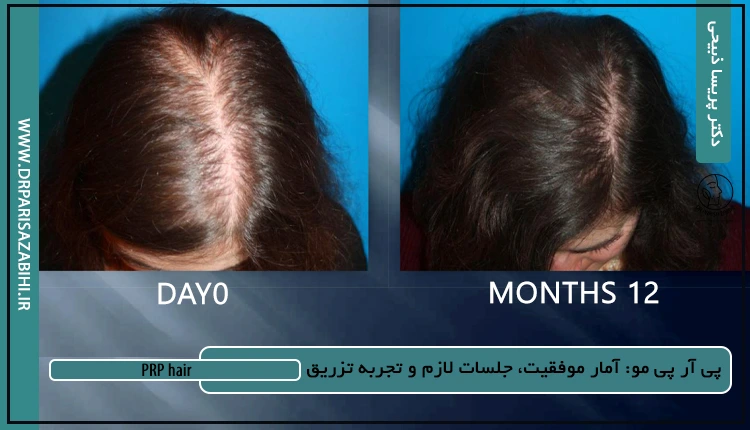 پی آر پی مو: آمار موفقیت، جلسات لازم و تجربه تزریق 2 پی آر پی مو: آمار موفقیت، جلسات لازم و تجربه تزریق