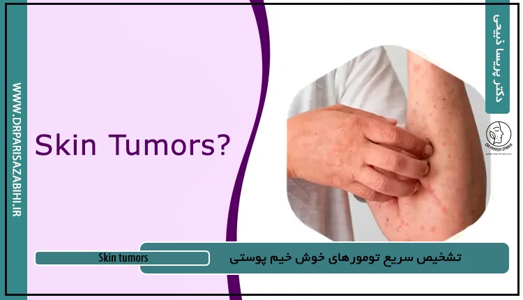 تشخیص سریع تومورهای خوش خیم پوستی 2 تشخیص سریع تومورهای خوش خیم پوستی