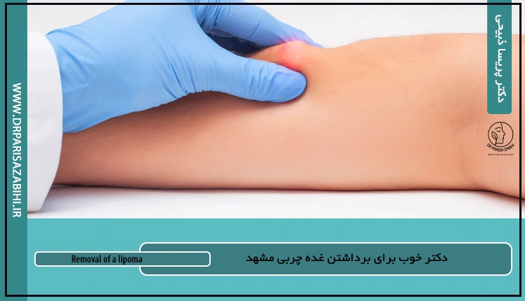دکتر خوب برای برداشتن غده چربی مشهد 2 دکتر خوب برای برداشتن غده چربی مشهد