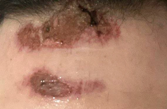 اصلاح و ترمیم اسکار تصادف و جراحات در مشهد: بازسازی زیبایی و اعتماد 1 قبل از جراحی اسکار تصادف توسط دکتر پریسا ذبیحی