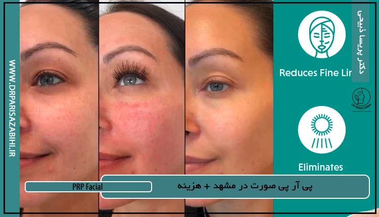 پی آر پی صورت در مشهد + هزینه 2 پی آر پی صورت در مشهد + هزینه