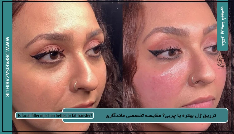 تزریق ژل بهتره یا چربی؟ مقایسه تخصصی ماندگاری 2 تزریق ژل بهتره یا چربی؟ مقایسه تخصصی ماندگاری