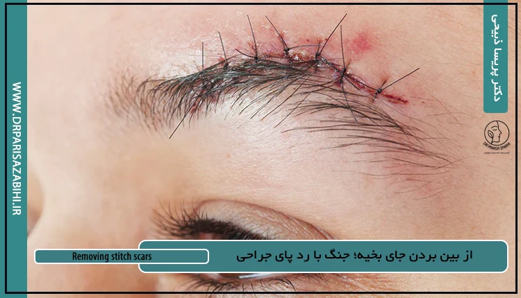 از بین بردن جای بخیه؛ جنگ با رد پای جراحی 2 از بین بردن جای بخیه؛ جنگ با رد پای جراحی