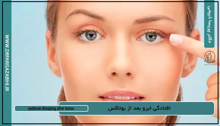 افتادگی ابرو بعد از بوتاکس 7 افتادگی ابرو بعد از بوتاکس