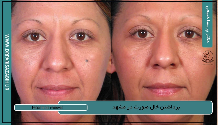 برداشتن خال صورت در مشهد 10 برداشتن خال صورت در مشهد