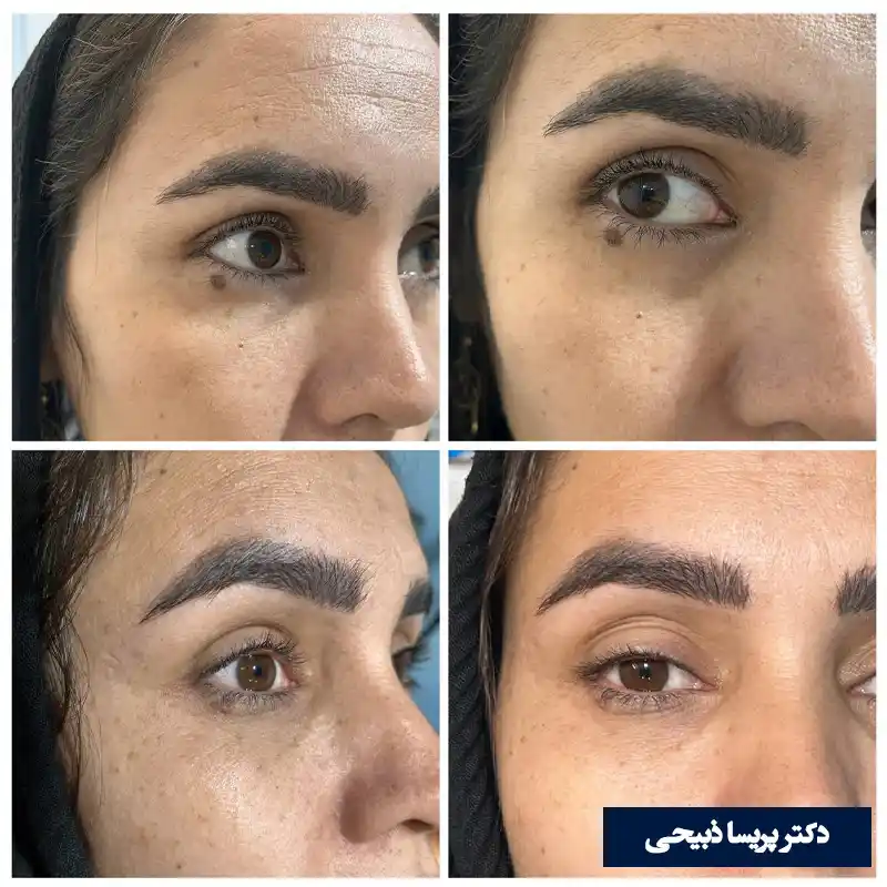 برداشتن خال گوشتی زیر چشم دکتر پریسا ذبیحی مشهد