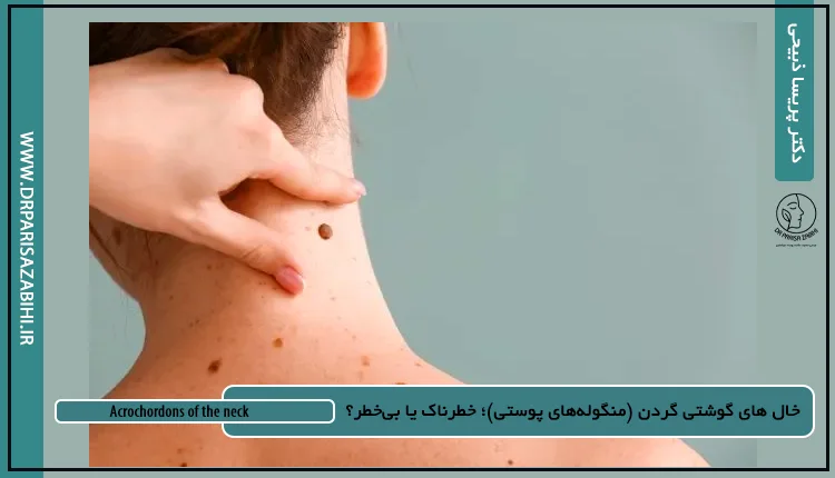 پوست و مو، ژل، بوتاکس و جراحی محدود مشهد 12 خال های گوشتی گردن