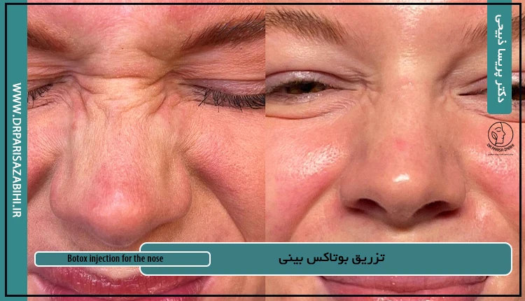 تزریق بوتاکس بینی 2 Botox injection for the nose