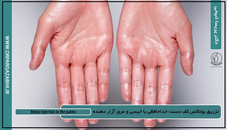 تزریق بوتاکس کف دست؛ خداحافظی با خیسی و عرق آزار دهنده 4 Botox injection in the palms