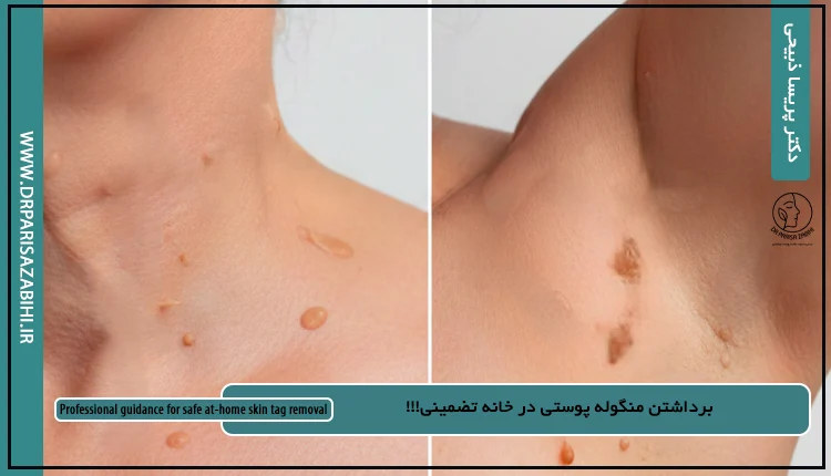 برداشتن منگوله پوستی در خانه تضمینی!!! 1 برداشتن منگوله پوستی در خانه تضمینی!!!