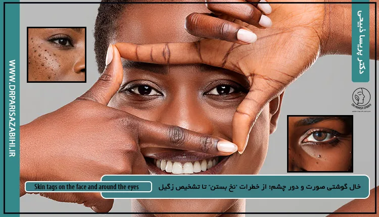 خال گوشتی صورت و دور چشم؛ از خطرات "نخ بستن" تا تشخیص زگیل 5 خال گوشتی صورت و دور چشم؛ از خطرات "نخ بستن" تا تشخیص زگیل