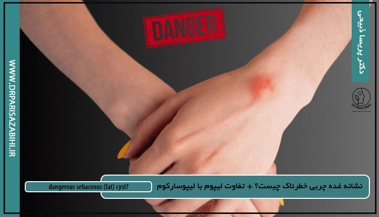 نشانه غده چربی خطرناک چیست؟ + تفاوت لیپوم با لیپوسارکوم 2 What are the signs of a dangerous sebaceous fatcyst