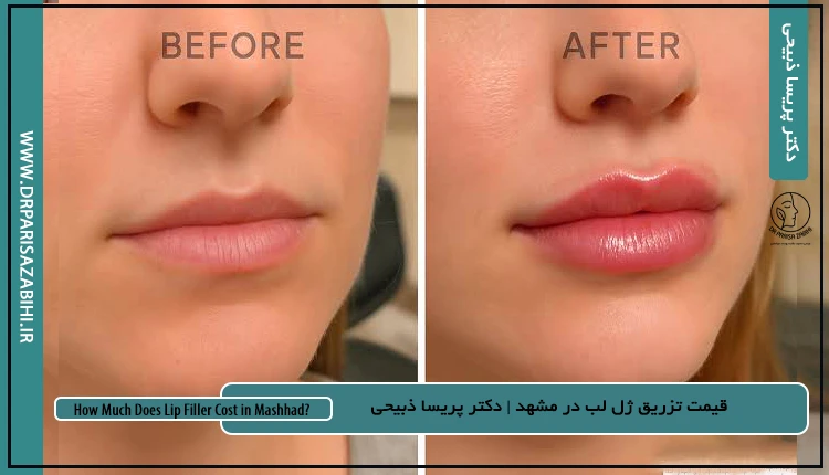 قیمت تزریق ژل لب در مشهد ۱۴۰۵ 2 قیمت تزریق ژل لب در مشهد