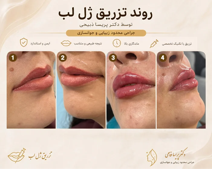 تزریق ژل در مشهد: جوانسازی و حجمدهی با بالاترین کیفیت 3 تزریق ژل لب توسط- دکتر پریسا ذبیحی