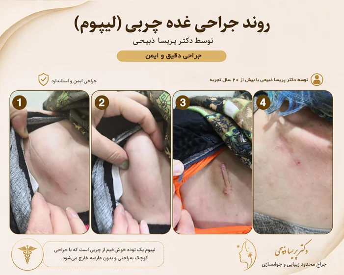 جراحی غده چربی توسط- دکتر پریسا ذبیحی