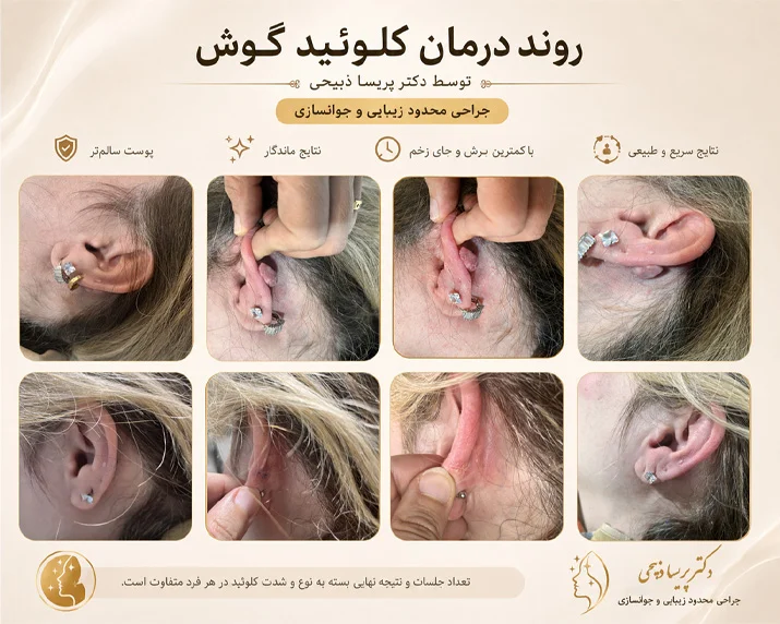 روند درمان کلوئید گوش توسط دکتر پریسا ذبیحی
