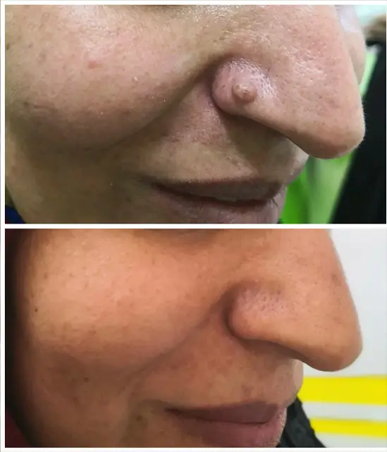 خالبرداری از روی بینی دکتر پریسا ذبیحی