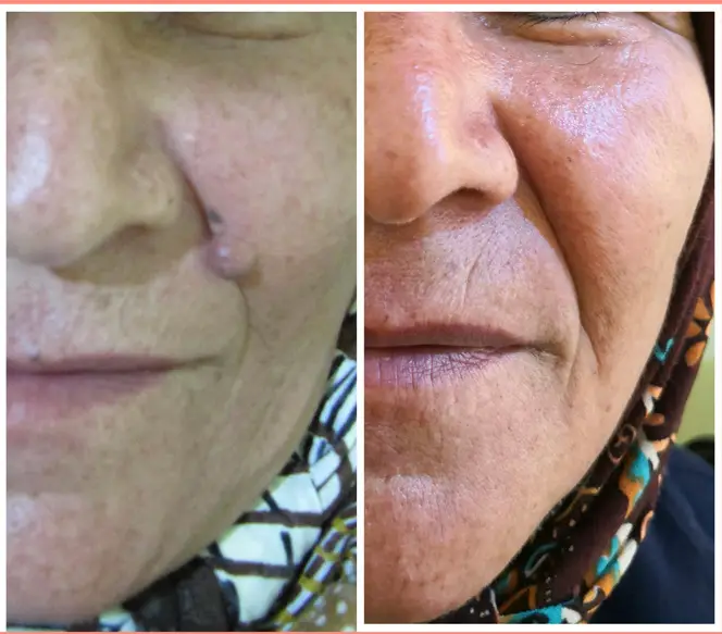 خالبرداری از روی صورت بصورت تخصصی دکتر پریسا ذبیحی
