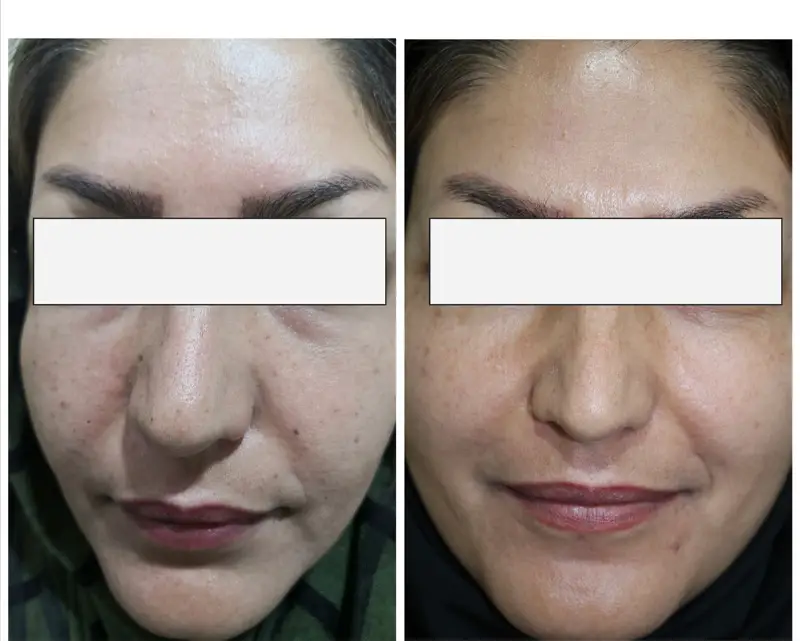 خالبرداری از روی صورت دکتر پریسا ذبیحی