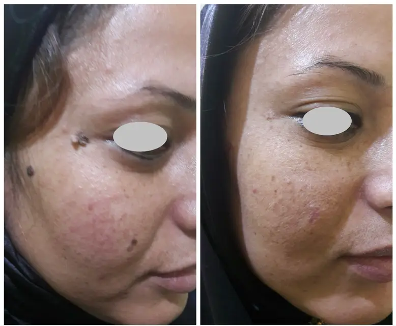 خالبرداری از روی صورت و پاکسازی دکتر پریسا ذبیحی