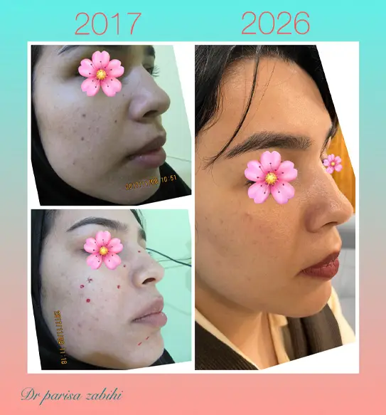 خالبرداری از روی صورت و پاکسازی صورت دکتر پریسا ذبیحی