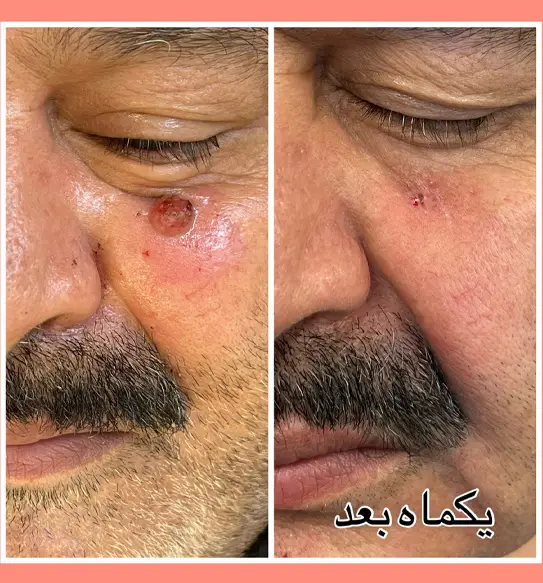خالبرداری از زیر چشم دکتر پریسا ذبیحی
