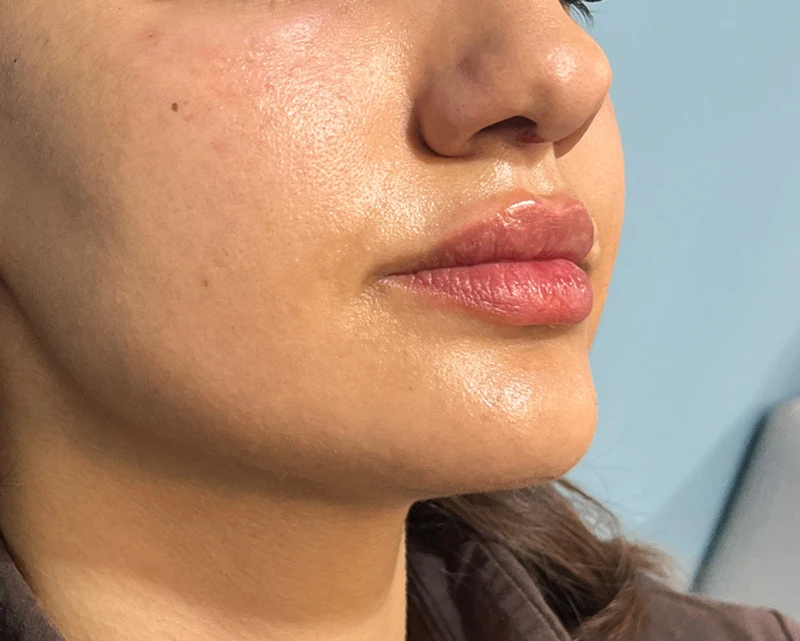 عکس بعد ازتزریق ژل لب توسط دکتر پریسا ذبیحی