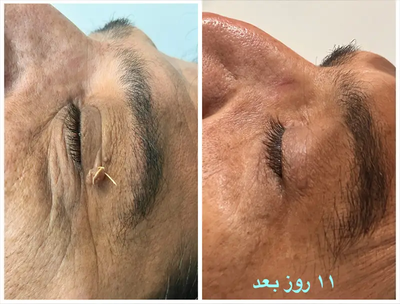 عکس قبل و بعد دکتر پریسا ذبیحی خالبرداری
