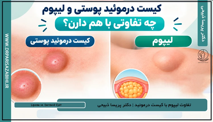 برآمدگی روی سر و بدن؛ تفاوت لیپوم با کیست درموئید