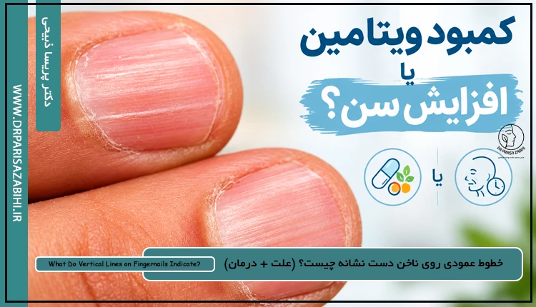 خطوط عمودی روی ناخن دست نشانه چیست؟ (علت + درمان)